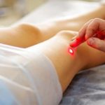 Laser varices
