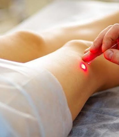 Laser varices