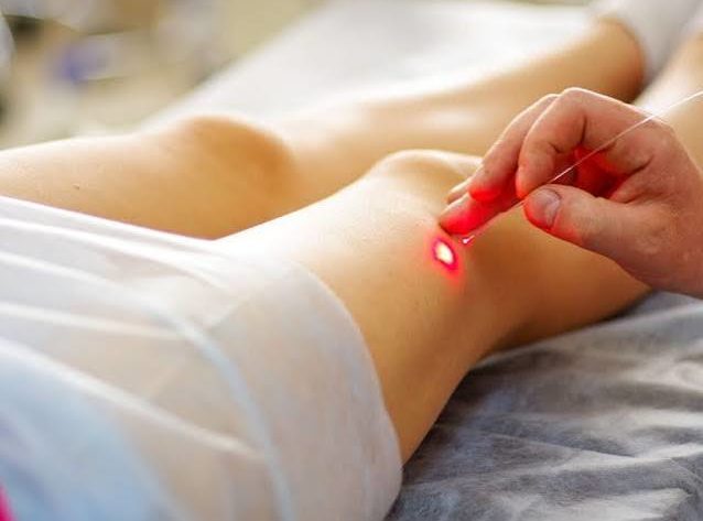 Laser varices