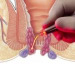 hemoroide laser