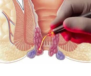 hemoroide laser